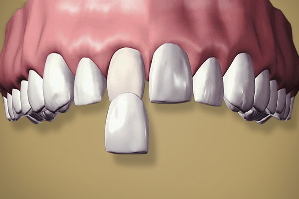 Dental Veneers