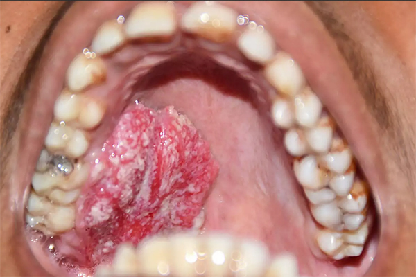 Oral Cancer