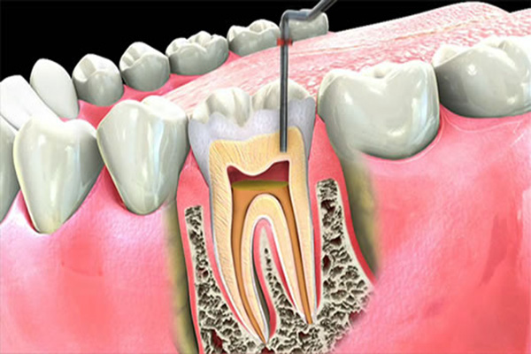 Tooth Root Canal