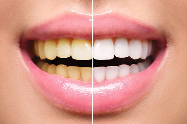 Tooth Bleaching