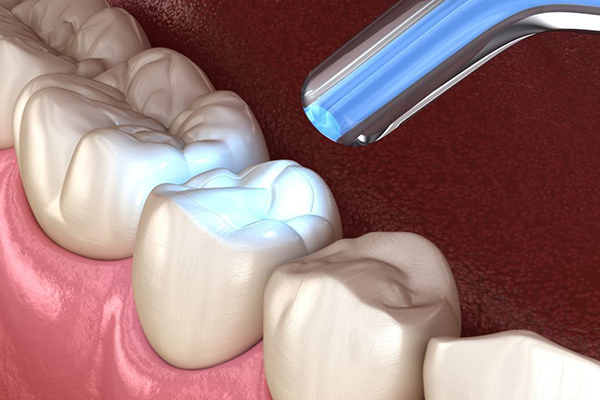 Tooth Restoration